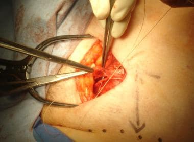 Open inguinal hernia repair. Closure of external o