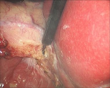 Laparoscopic cholecystectomy. Use of traction and 