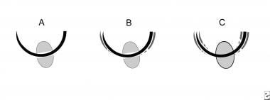 Interaction between needle holder and suture needl