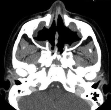 CT of sinuses in a patient with Wegener granulomat