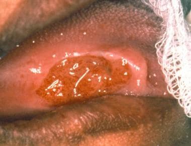 A 47-year-old African American woman with an eosin