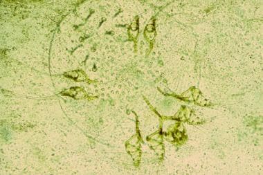 Scabies mite scraped from a burrow (original magni