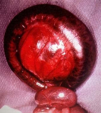 Intestinal obstruction in the newborn. Volvulus of