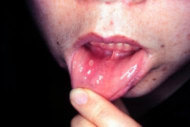 Minor aphthous ulcer. 