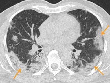 Axial chest CT shows bilateral patchy consolidatio