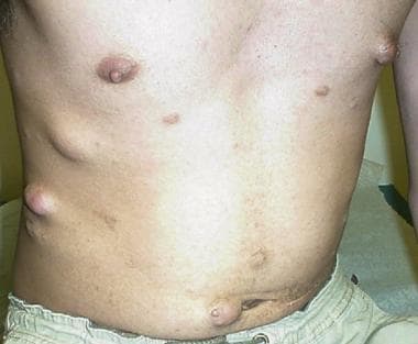 Subcutaneous and cutaneous lesions in a young man 