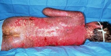 stevens johnson syndrome rash