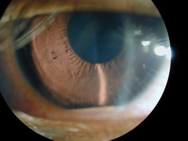 Acute anterior uveitis with hypopyon in a child. C