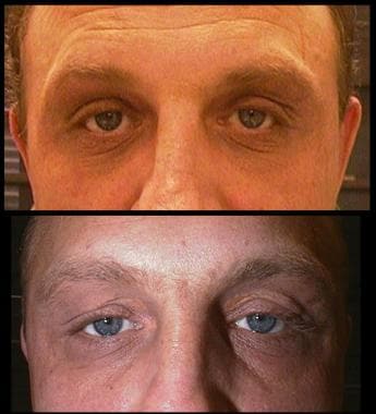 Eyelid Springs - Lagophthalmos Treatment