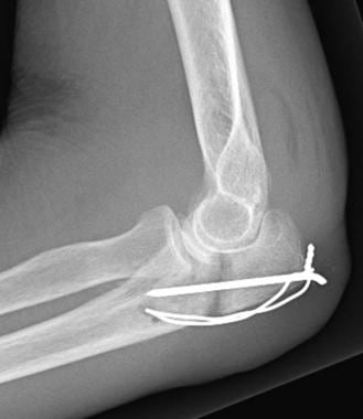 Nonunion of olecranon fracture in 79-year-old man 