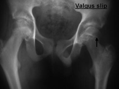 slipped capital femoral epiphysis