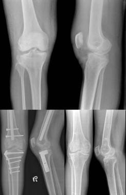 Tibial Plateau Fractures Treatment Management Approach