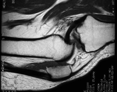 Sagittal T1-weighted MRI of knee in patient with s