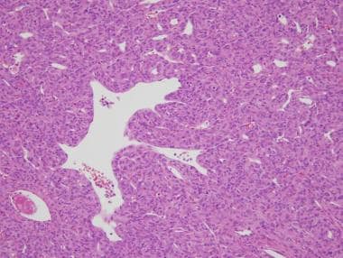 Histology of solitary fibrous tumor demonstrates a