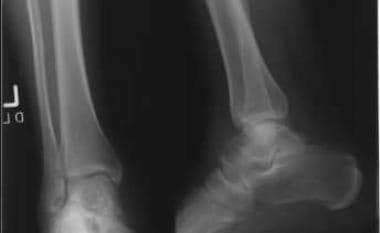 Oblique and lateral radiographs of ankle reveal lu