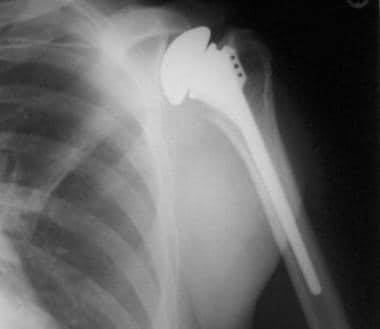 Shoulder hemiarthroplasty in a patient with should