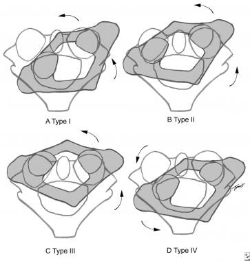Shown are 4 types of atlantoaxial rotatory subluxa