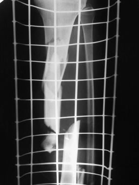 Clinical Case 1. Preoperative radiograph of the tr