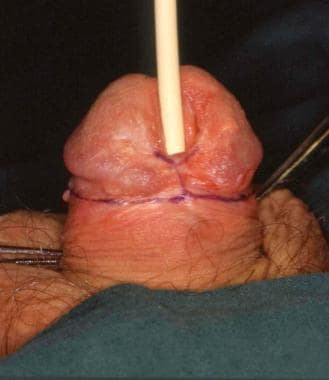 Distal penile epispadias. 