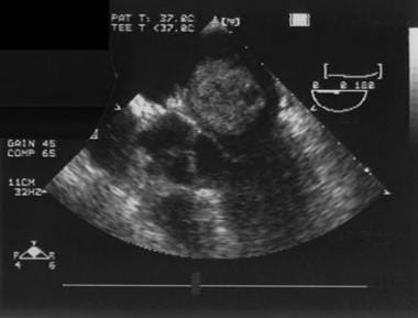 Atrial myxoma. This is a transesophageal echocardi