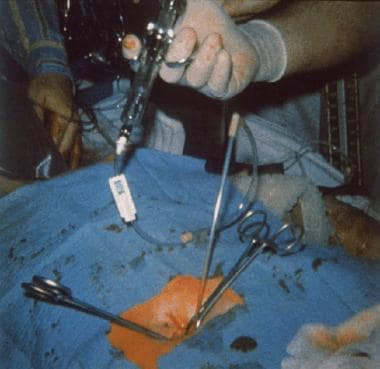 A standard diagnostic peritoneal lavage (DPL) cath