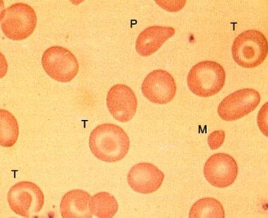 Peripheral smear in beta-zero thalassemia minor sh