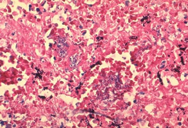 Histopathology of mediastinal lymph node showing a