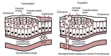 The left panel is transudation of serum antibodies