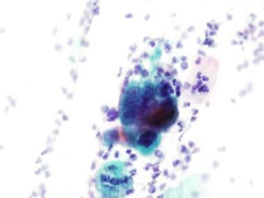 Papanicolaou (Pap) stain, high power, showing the 