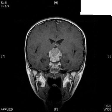 MRI of the brain - T1 weighted-image- coronal view