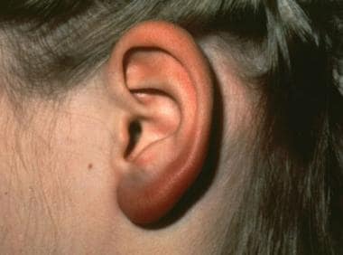 Lyme disease. Borrelial lymphocytoma of the earlob
