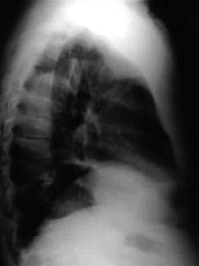 Best Practices: Tube Thoracostomy Insertion