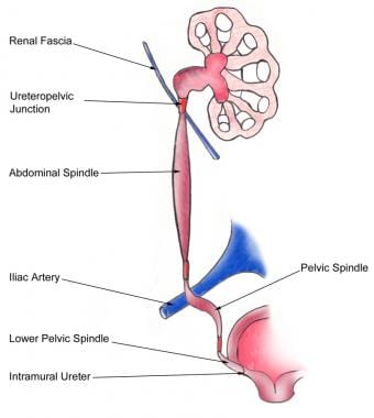 肾石症:急性肾绞痛。解剖解剖学