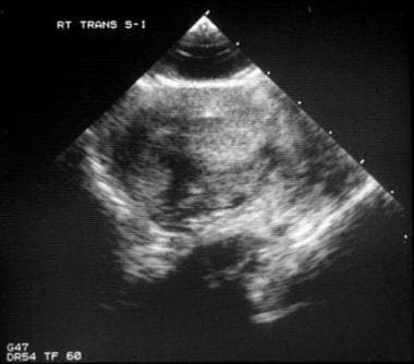 This scrotal sonogram shows a fractured testis wit
