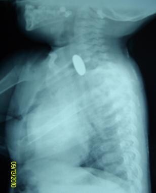 Lateral chest radiograph of a child with a nickel 
