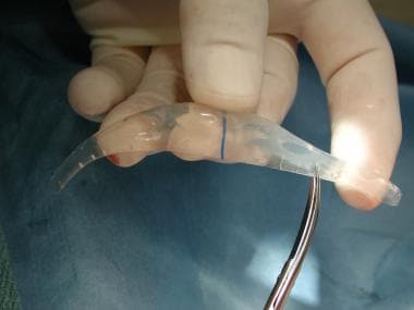 An alloplastic chin implant. 