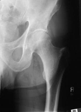 A subcapital femoral neck fracture. Slight compres