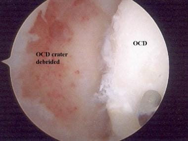 Arthroscopic debridement of the osteochondritis di
