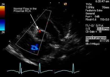 Surgical Approach to Anomalous Left Coronary Artery From the Pulmonary ...