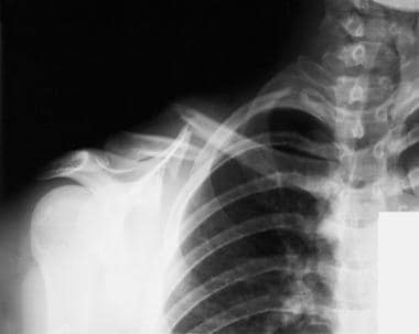 clavicle fracture newborn