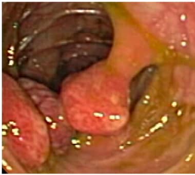 Multiple large polyps in the colon. The polyp in t