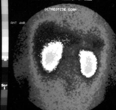 Somatostatin receptor scintigraphy in a young pati