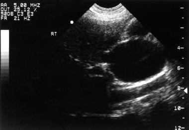 Ultrasonogram shows a large unilocular cyst under 