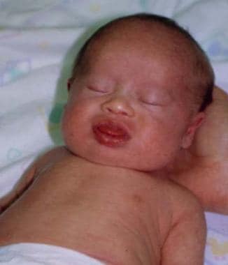 Infant with Down syndrome. Note up-slanting palpeb