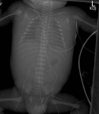 Chest and abdomen radiograph revealing the presenc