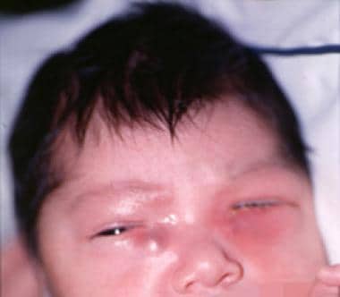 Frontal view of a 2-day-old infant with swelling i