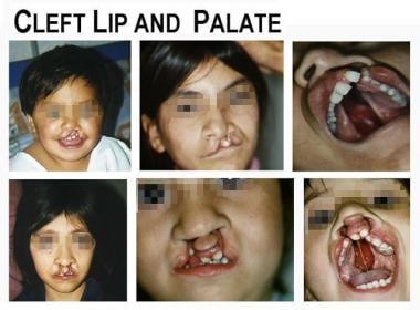 Examples of cleft lip and palate. 