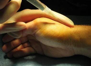 Corticosteroid injection into thumb for de Quervai