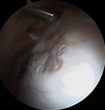 Hip arthroscopy. Cam lesion with adjacent cartilag