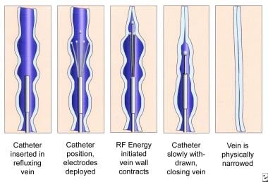 Schematic images of the process of radiofrequency 
